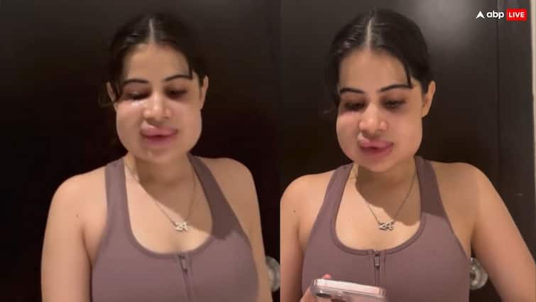 सूज गए होंठ- फूल गया चेहरा, फिलर्स करवाना Uorfi Javed को पड़ गया भारी, पहचान नहीं पा रहे लोग, बॉयफ्रेंड ने कह दिया ये