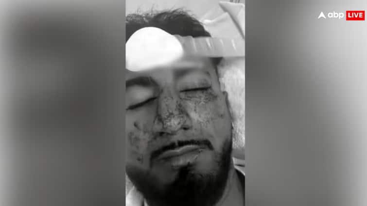 ऑस्ट्रेलिया में पार्किंग विवाद के बाद भारतीय छात्र पर नस्लीय हमला, घेरकर पीटा, कहा- भागो इंडियन