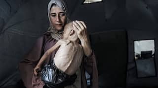 Israel Gaza starvation crisis: इस्रायलकडून गाझापट्टीची नाकेबंदी, 70 हजार मुलांचं कुपोषण, 'तो' भयानक फोटो सोशल मीडियावर व्हायरल