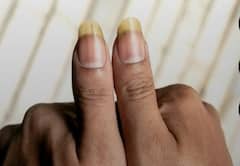 कहीं आपकी उंगलियां तो नहीं दे रहीं लिवर डैमेज का संकेत? जानिए लक्षण