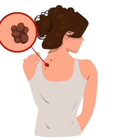 ਜੇ ਤੁਹਾਡੀ ਚਮੜੀ ਵਾਰ-ਵਾਰ ਨੀਲੀ ਹੋ ਰਹੀ ਹੈ ਤਾਂ ਇਹ ਦਿਲ ਦੀ ਬਿਮਾਰੀ ਦਾ ਇਸ਼ਾਰਾ ਹੋ ਸਕਦਾ ਹੈ। ਇਸਨੂੰ ਸਾਇਨੋਸਿਸ ਕਿਹਾ ਜਾਂਦਾ ਹੈ। ਇਹ ਲੱਛਣ ਆਮ ਤੌਰ 'ਤੇ ਬੁੱਲ੍ਹਾਂ, ਹੱਥਾਂ ਜਾਂ ਪੈਰਾਂ ਦੀਆਂ ਉਂਗਲਾਂ 'ਤੇ ਨਜ਼ਰ ਆਉਂਦੇ ਹਨ।