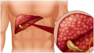 Liver Fat : కాలేయంలో కొవ్వును తగ్గించే ఇంటి చిట్కాలు ఇవే.. వీటిని తప్పక తీసుకోండి