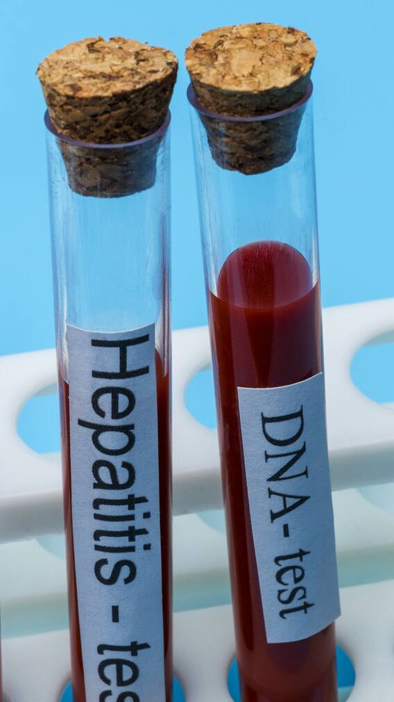 World Hepatitis Day 2025: Who Is Most Susceptible To Hepatitis?