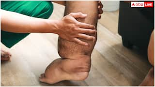 भारत के किस राज्य में फाइलेरिया के सबसे ज्यादा मरीज, किस वजह से होती है यह बीमारी और कितनी खतरनाक?