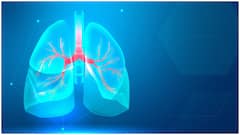 ఊపిరితిత్తుల క్యాన్సర్​ లక్షణాలివే.. ముందుగానే గుర్తించి, ప్రాణాలు కాపాడుకోండిలా