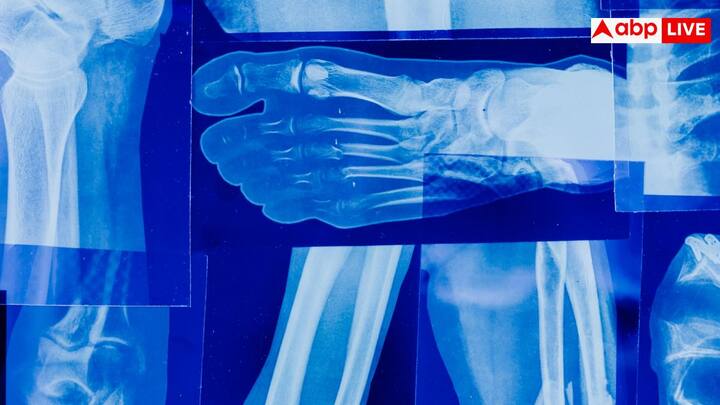 यह सामग्री शरीर में घुल जाती है और नई हड्डी जैसी ही मजबूत हड्डी बनाती है. इसकी ताकत और बनावट प्राकृतिक हड्डी जैसी है.