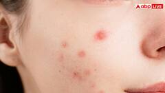 क्या बासी थूक लगाने से सच में सही हो जाते हैं पिंपल्स और सफेद दाग, डॉक्टर से जानें सही बात