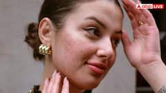 क्या बासी थूक लगाने से सच में सही हो जाते हैं पिंपल्स और सफेद दाग, डॉक्टर से जानें सही बात