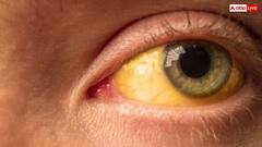 पीलिया को नजरअंदाज करना पड़ सकता है भारी! घर बैठे इस तरह करें पहचान