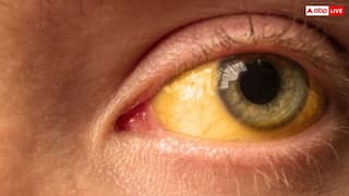 पीलिया को नजरअंदाज करना पड़ सकता है भारी! घर बैठे इस तरह करें पहचान