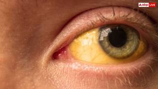 மஞ்சள் காமாலைக்கான காரணங்கள், வகைகள் & ஆபத்துகள்! அலட்சியம் செய்தால் உயிருக்கு ஆபத்து!