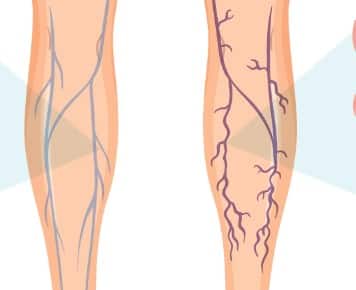 परिधीय संचार विकार: (Peripheral Artery Disease - PAD) पैरों तक ब्लड सप्लाई कम हो जाती है, जिससे ऑक्सीजन की कमी से नसों में जलन, दर्द या ऐंठन हो सकती है. यह स्थिति दिल की बीमारियों से भी जुड़ी हो सकती है.