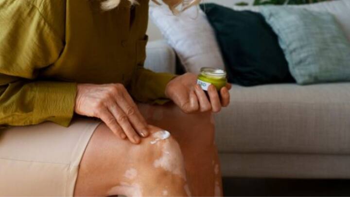 অ্যালোভেরা জেলও ব্যবহার করতে পারেন। আলুর রস লাগালেও উপকার মিলবে।