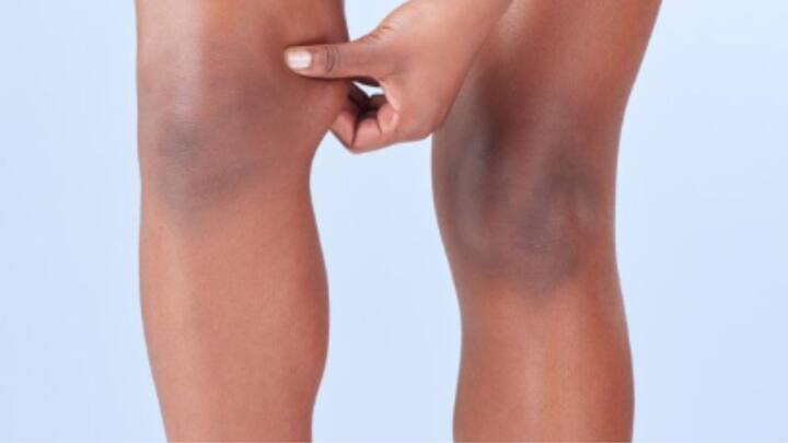 লেবুর রস ও মধু মিশিয়ে নিন ভাল করে। লাগিয়ে রাখুন ১৫-২০ মিনিট। সপ্তাহে দু’-তিন বার ব্যবহারেই উপকার পাবেন।