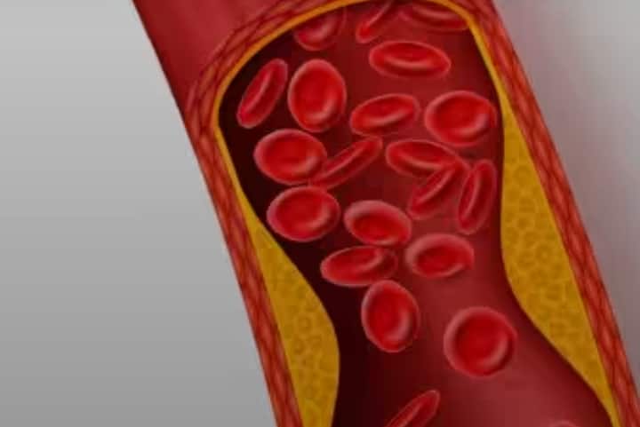 ਅਨੀਮੀਆ: ਛੋਲਿਆਂ ਵਿੱਚ ਆਇਰਨ ਦੀ ਮਾਤਰਾ ਜ਼ਿਆਦਾ ਹੁੰਦੀ ਹੈ, ਜੋ ਸਰੀਰ ਵਿੱਚ ਹੀਮੋਗਲੋਬਿਨ ਦੇ ਪੱਧਰ ਨੂੰ ਵਧਾਉਣ ਵਿੱਚ ਮਦਦ ਕਰਦਾ ਹੈ। ਭਿੱਜੇ ਹੋਏ ਛੋਲੇ ਔਰਤਾਂ ਲਈ ਖਾਸ ਤੌਰ 'ਤੇ ਫਾਇਦੇਮੰਦ ਹੁੰਦੇ ਹਨ, ਕਿਉਂਕਿ ਇਹ ਅਨੀਮੀਆ ਨੂੰ ਰੋਕਣ ਵਿੱਚ ਮਦਦ ਕਰਦੇ ਹਨ।