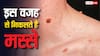 क्यों होते हैं मस्से और ये कितने खतरनाक? जान लें इलाज का सही तरीका