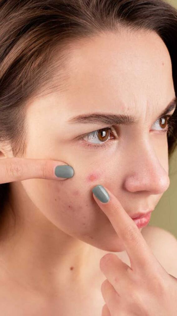 पिंपल्सवर थुंक लावणे योग्य आहे की नाही?