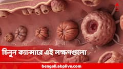 শুধু বয়স্করাই নন, কমবয়সীদের মধ্যেও বাড়ছে অন্ত্রের ক্যান্সার! এই সাধারণ লক্ষণই সঙ্কেত, কীভাবে বাঁচবেন?