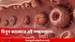 Cancer : শুধু বয়স্করাই নন, কমবয়সীদের মধ্যেও বাড়ছে অন্ত্রের ক্যান্সার! এই সাধারণ লক্ষণই সঙ্কেত, কীভাবে বাঁচবেন?