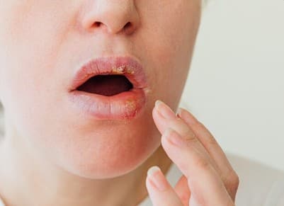 होंठ और त्वचा का सूखना: किडनी की समस्या में शरीर में नमी की कमी होने लगती है. इसका असर होंठों के फटने, त्वचा के रूखेपन और चेहरे पर चमक कम होने के रूप में दिख सकता है.