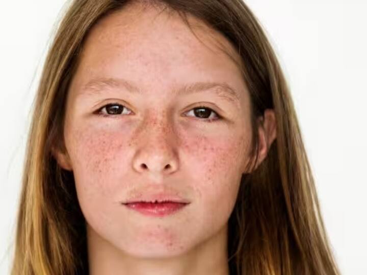 ચહેરા પર અસામાન્ય લાલાશ કે ફોલ્લીઓ: જ્યારે કિડનીને નુકસાન થાય છે, ત્યારે લોહીમાં રહેલા ઝેરી તત્વો બહાર નીકળી શકતા નથી અને ત્વચાને અસર કરી શકતા નથી. ચહેરા પર લાલ ફોલ્લીઓ, ખંજવાળ આના કારણે થઈ શકે છે.