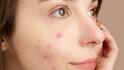 Acne Problems: ব্রন খুঁটে তোলেন? মারাত্মক ক্ষতি হতে পারে ত্বকের, আজই সতর্ক হোন