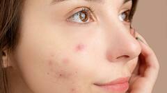 Acne Problems: ব্রন খুঁটে তোলেন? মারাত্মক ক্ষতি হতে পারে ত্বকের, আজই সতর্ক হোন