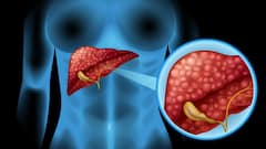 Liver Cirrhosis : এই ৬ কারণে হতে পারে লিভার সিরোসিস ! আপনিও এই ভুল করছেন না তো ?