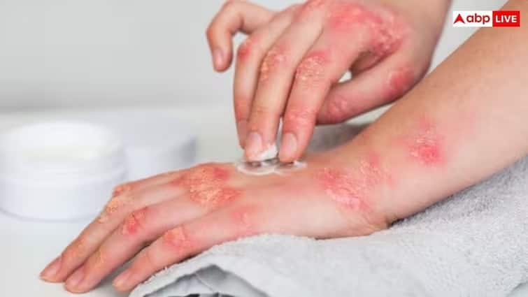 If this mark suddenly appears on the body, then be careful, it is a sign of cancer Health Alert: અચાનક શરીરમાં દેખાય છે આ નિશાન, તો સાવધાન, કેન્સરના છે સંકેત