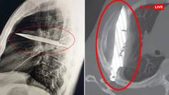 आठ सालों से छाती में घुसा था चाकू! निप्पल से मवाद निकलने पर हुआ खुलासा, हैरान रह गए डॉक्टर्स