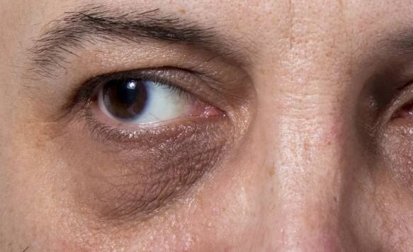 ਅੱਖਾਂ ਦੇ ਹੇਠਾਂ ਕਾਲੇ ਘੇਰੇ: ਕਿਡਨੀ ਦੀ ਬਿਮਾਰੀ ਵਿੱਚ, ਸਰੀਰ ਥਕਾਵਟ ਮਹਿਸੂਸ ਕਰਦਾ ਹੈ ਅਤੇ ਨੀਂਦ ਦੀ ਗੁਣਵੱਤਾ ਵੀ ਘੱਟ ਜਾਂਦੀ ਹੈ। ਇਸਦਾ ਸਿੱਧਾ ਪ੍ਰਭਾਵ ਅੱਖਾਂ ਦੇ ਹੇਠਾਂ ਕਾਲੇ ਘੇਰਿਆਂ ਦੇ ਰੂਪ ਵਿੱਚ ਦਿਖਾਈ ਦਿੰਦਾ ਹੈ।