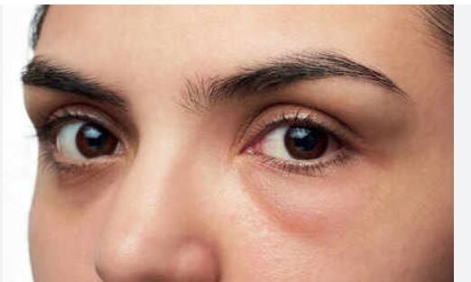 ਅੱਖਾਂ ਦੇ ਆਲੇ-ਦੁਆਲੇ ਸੋਜ: ਜੇਕਰ ਸਵੇਰੇ ਉੱਠਦੇ ਹੀ ਤੁਹਾਡੀਆਂ ਅੱਖਾਂ ਦੇ ਹੇਠਾਂ ਜਾਂ ਆਲੇ-ਦੁਆਲੇ ਸੋਜ (ਸੋਜ) ਹੁੰਦੀ ਹੈ, ਤਾਂ ਇਹ ਸਿਰਫ਼ ਨੀਂਦ ਦੀ ਕਮੀ ਜਾਂ ਐਲਰਜੀ ਨਹੀਂ ਹੋ ਸਕਦੀ। ਕਿਡਨੀ ਫੇਲ੍ਹ ਹੋਣ ਵਿੱਚ, ਸਰੀਰ ਵਿੱਚ ਪਾਣੀ ਜੰਮਣਾ ਸ਼ੁਰੂ ਹੋ ਜਾਂਦਾ ਹੈ, ਜਿਸ ਕਾਰਨ ਚਿਹਰੇ ਦਾ ਇਹ ਹਿੱਸਾ ਸੁੱਜ ਜਾਂਦਾ ਹੈ।