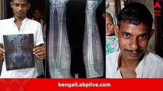 Malda News: শেষ হয়েও হচ্ছে না শেষ, মালদার যুবকের শরীরে কোথা থেকে এল অগণিত সূচ! এক্স-রে দেখে স্তম্ভিত সকলে
