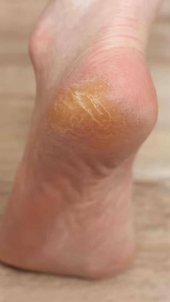 'या' गोष्टीच्या कमतरतेमुळे टाचांना भेगा पडतात?