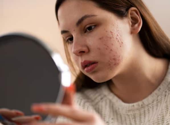 चमकदार त्वचा के लिए: नीम के पत्ते मुंहासे, फोड़े-फुंसी, खुजली और अन्य त्वचा संक्रमणों के लिए बेहद कारगर हैं। ये रक्त को शुद्ध करते हैं, जिससे त्वचा साफ़ और चमकदार हो जाती है।