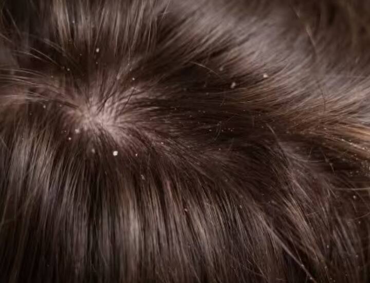 ਡੈਂਡਰਫ ਤੋਂ ਮਿਲਦੀ ਰਾਹਤ: ਗਲਿਸਰੀਨ ਵਿੱਚ ਐਂਟੀ-ਬੈਕਟੀਰੀਅਲ ਗੁਣ ਹੁੰਦੇ ਹਨ, ਜੋ ਸਕੈਲਪ ਨੂੰ ਹਾਈਡ੍ਰੇਟ ਰੱਖਦੇ ਹਨ ਅਤੇ ਡੈਂਡਰਫ ਦੀ ਸਮੱਸਿਆ ਨੂੰ ਘਟਾਉਂਦੇ ਹਨ।