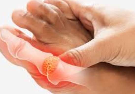 गाउट: यह एक तरह का आर्थराइटिस है जिसमें यूरिक एसिड क्रिस्टल्स जोड़ों में जमा हो जाते हैं. गाउट का असर अक्सर कलाई और उंगलियों में दिखाई देता है, जिससे सूजन और तेज दर्द होता है.