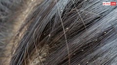 बरसात में बालों में हो गए हैं जुएं? इन नुस्खों से 1 सप्ताह में गायब करें सारी लीख