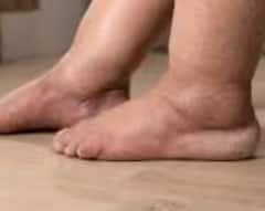 ਕਿਡਨੀ ਖ਼ਰਾਬ ਹੋਣ 'ਤੇ ਨਜ਼ਰ ਆਉਂਦੇ ਆਹ ਲੱਛਣ, ਭੁੱਲ ਕੇ ਵੀ ਨਾ ਕਰੋ ਇਗਨੋਰ