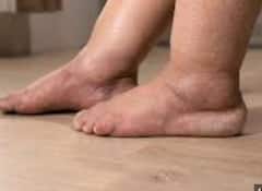 किडनी खराब होने पर ये संकेत आते हैं नजर, बिल्कुल नहीं करना चाहिए इग्नोर