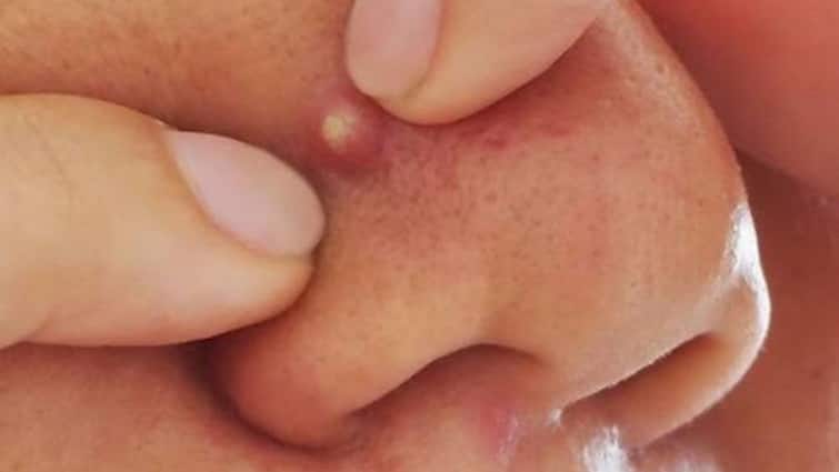 इस जगह पर कभी न फोड़े पिंपल…. ट्रायंगल ऑफ डेथ ले सकता है आपकी जान