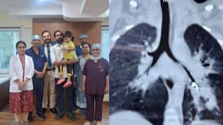चिमुकल्याचा खोकला तीन महिने थांबेना, सर्व उपचार केले, तीन महिन्यांनी कळलं LED बल्ब गिळला, यशस्वी शस्त्रक्रिया
