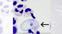 Brain Eating Amoeba : 'সাঁতারেও' হতে পারে এই মস্তিষ্ক-খেকো অ্যামিবার সংক্রমণ ! কেরলে মৃত ১৯, রাজ্যে বহু পজিটিভ কেস, কী কী নজরে রাখবেন ? জানালেন চিকিৎসক