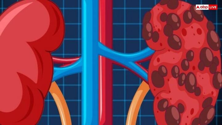 Kidney Health: ਕਿਡਨੀ ਸਟੋਨ ਇੱਕ ਬਹੁਤ ਹੀ ਆਮ ਪਰ ਗੰਭੀਰ ਸਿਹਤ ਸਮੱਸਿਆ ਹੈ। ਇਸ ਨੂੰ ਮੈਡੀਕਲ ਭਾਸ਼ਾ ਵਿੱਚ ਰੀਨਲ ਕੈਲਕੂਲੀ ਵੀ ਕਿਹਾ ਜਾਂਦਾ ਹੈ...