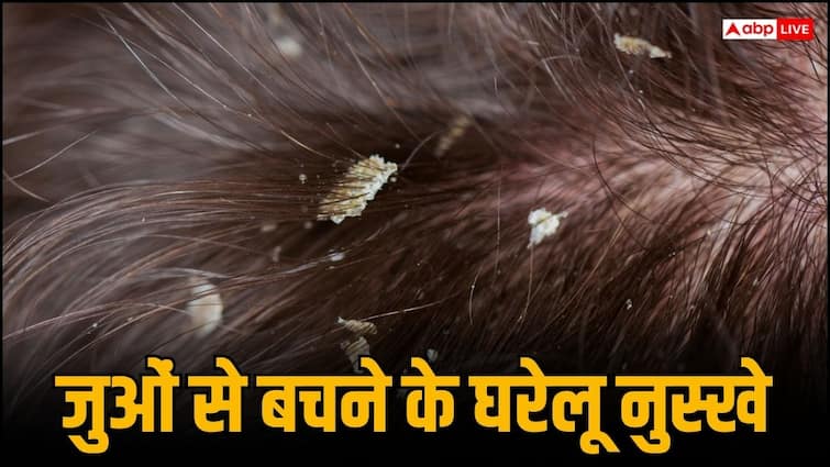सिर में जुओं से हैं परेशान? इन घरेलू उपायों से मिल जाएगा छुटकारा