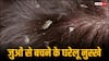 सिर में जुओं से हैं परेशान? इन घरेलू उपायों से मिल जाएगा छुटकारा