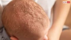 न्यू बॉर्न बेबी के सिर पर क्यों जम जाती है पपड़ी, जानें कैसे करें देखभाल