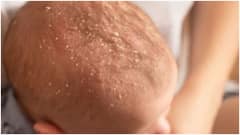 నవజాత శిశువుల తలపై పొలుసులకు కారణాలు, ఇంటి చిట్కాలు ఇవే.. వైద్యుడిని ఎప్పుడు సంప్రదించాలంటే