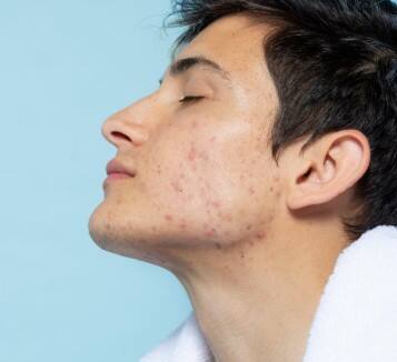 त्वचा में बदलाव: गले, कांख या कोहनी के पास काली और मोटी त्वचा (डार्क पैचेज़) बनना इंसुलिन रेजिस्टेंस का एक खास लक्षण है.