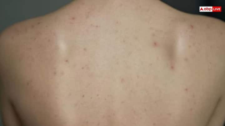 Home Remedies for Back Acne: पीठ पर मुंहासों से छुटकारा पाने के लिए आसान घरेलू उपाय, जो खुजली, जलन और दाग-धब्बों को कम करने में मददगार हैं.